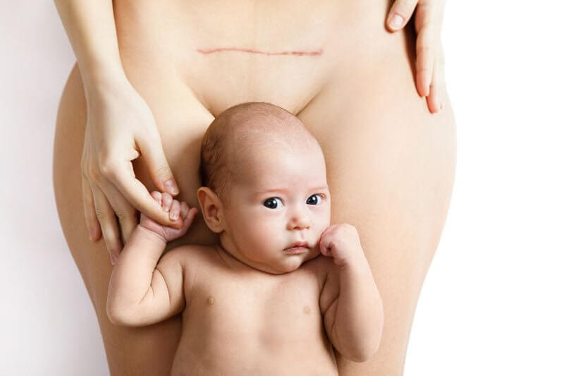 Les spécificités de la surveillance du post-partum pour un accouchement par  césarienne
